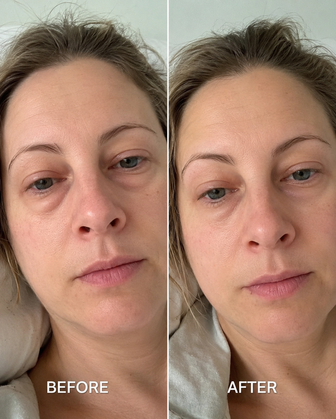 Before and after showing de-puffed eye bags and plumper under-eyes