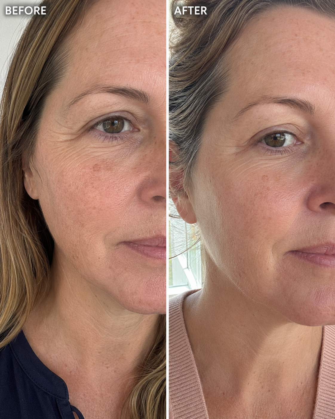 Before and after showing a firmer, lifted eye area